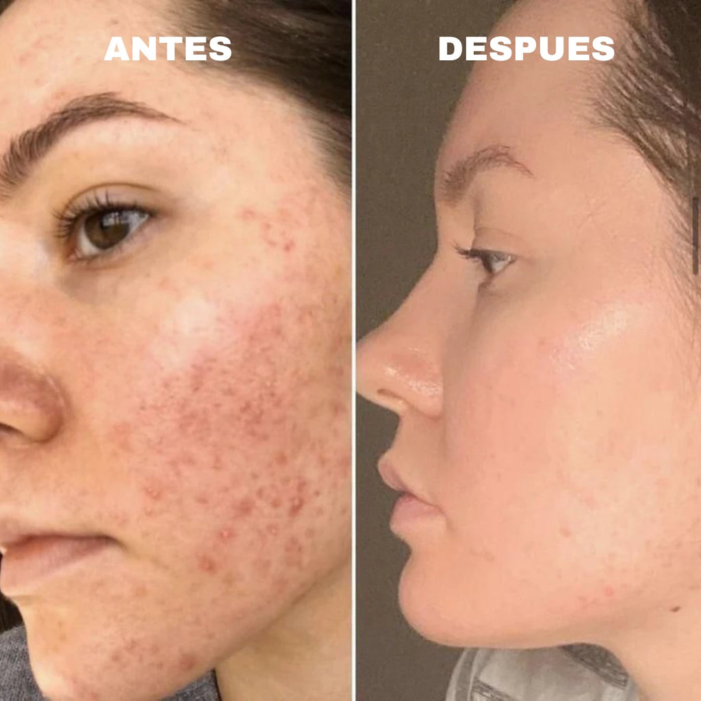 ANUA®️ NIACINAMIDE 10% + TXA 4% serum antimanchas 30 ml
