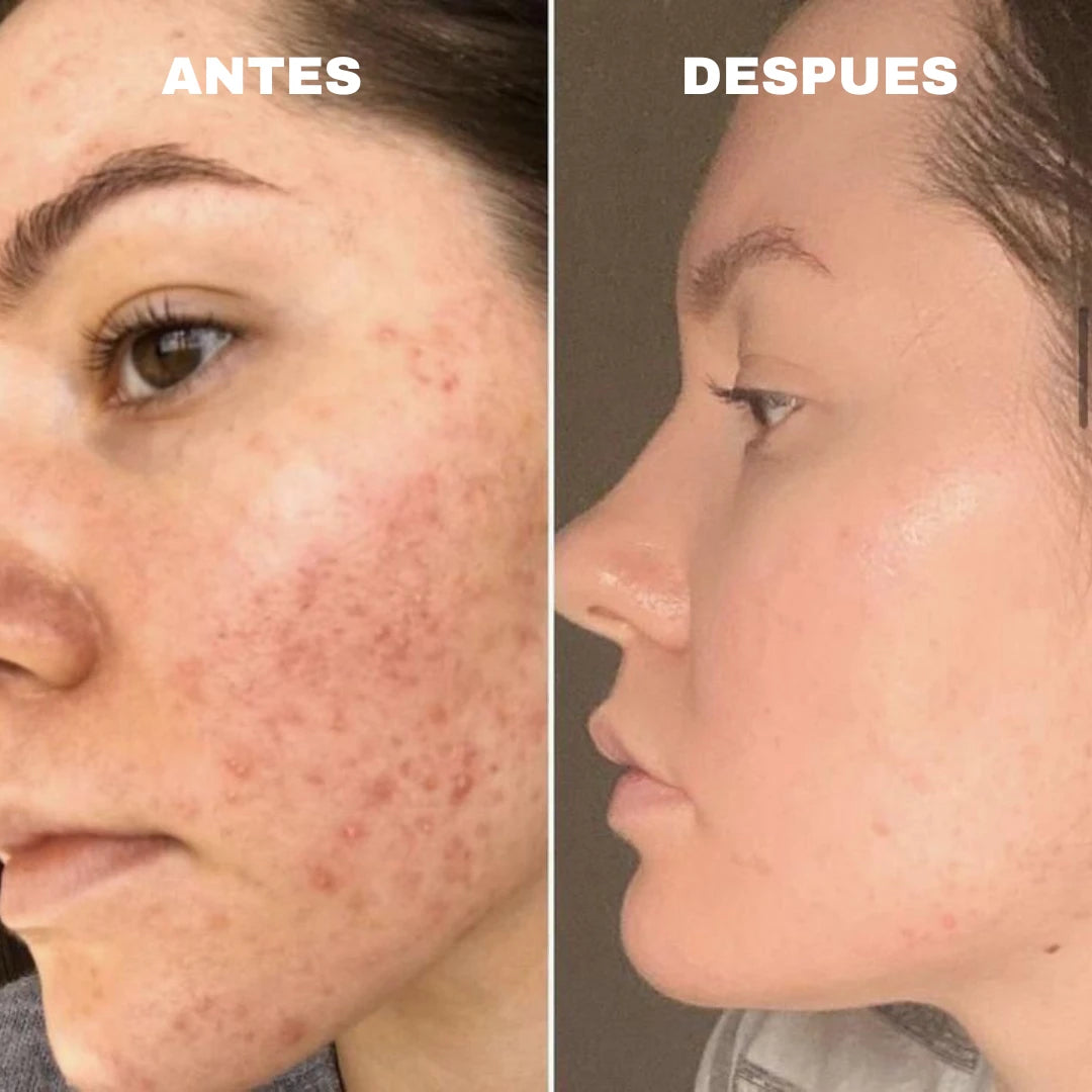 ANUA®️ NIACINAMIDE 10% + TXA 4% serum antimanchas 30 ml